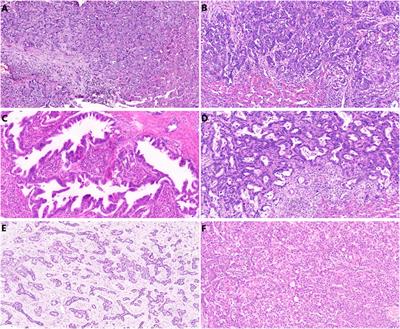 FOXF1 as an Immunohistochemical Marker of Hilar Cholangiocarcinoma or Metastatic Pancreatic Ductal Adenocarcinoma. Single Institution Experience